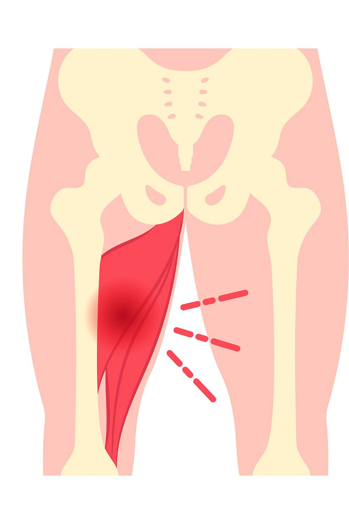 Inner thigh/groin pain