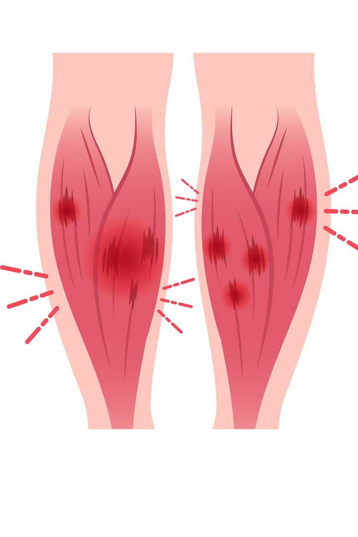 tendon soleus ankle swollen medial head leg shin sport fatigue Deep vein tendon running Medial