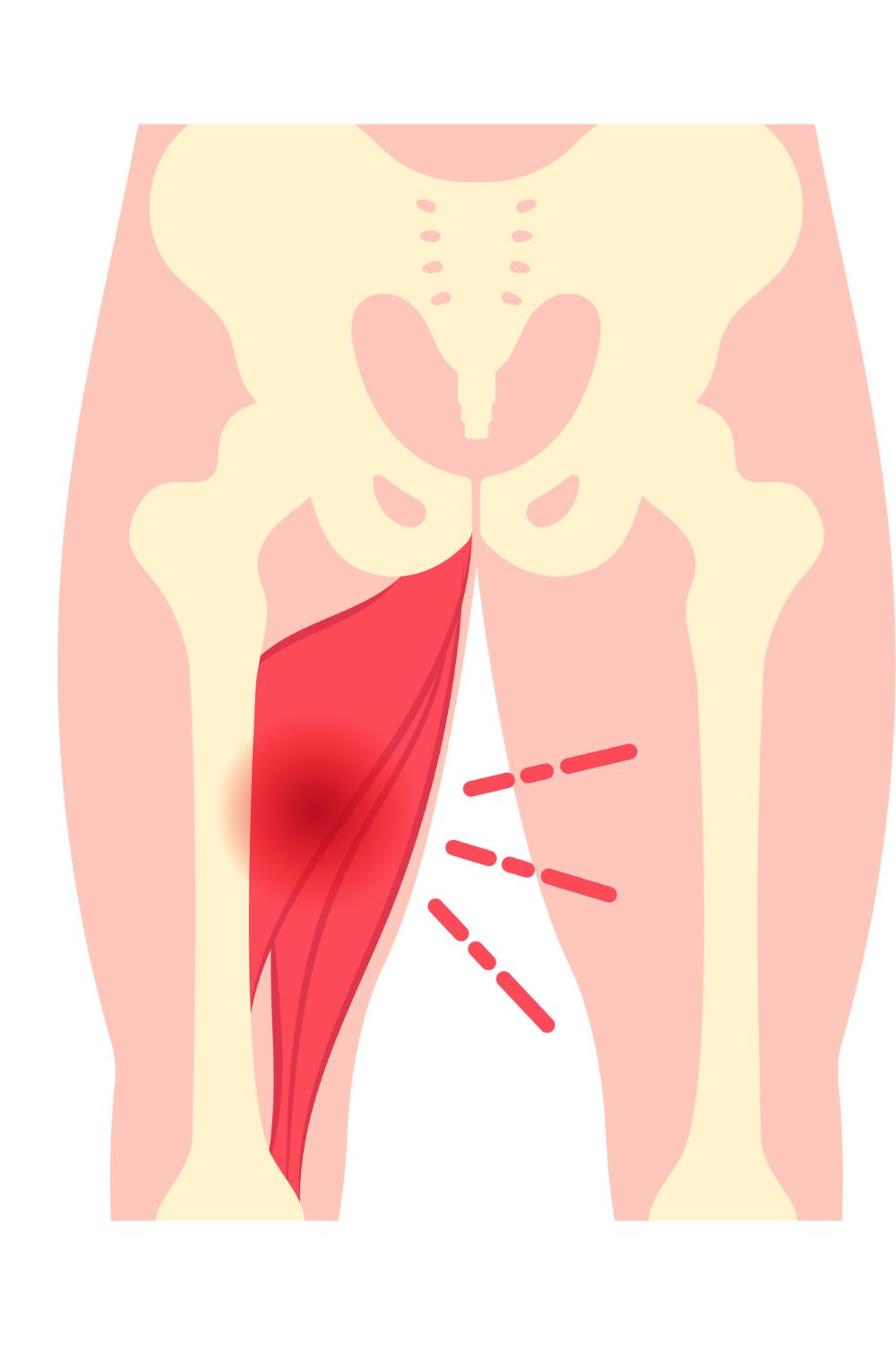 inner-thigh-groin-pain-on-one-side-during-squat-why-jsquat